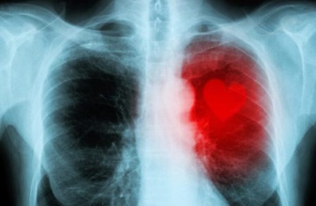 Broken heart syndrome deadlier for men than women - Study finds